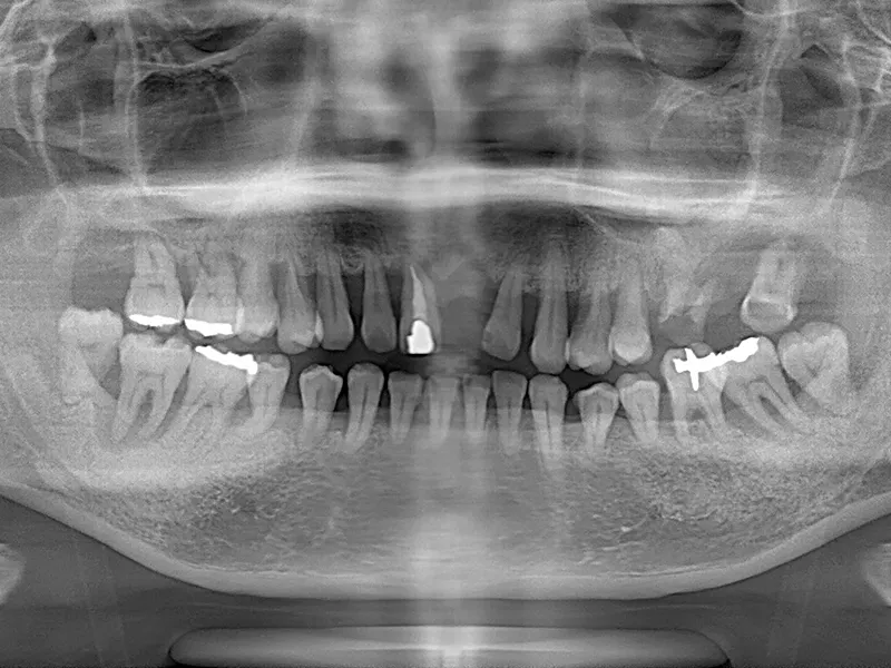 オールオン4治療前の口腔内写真2枚目（重度歯周病の状態）