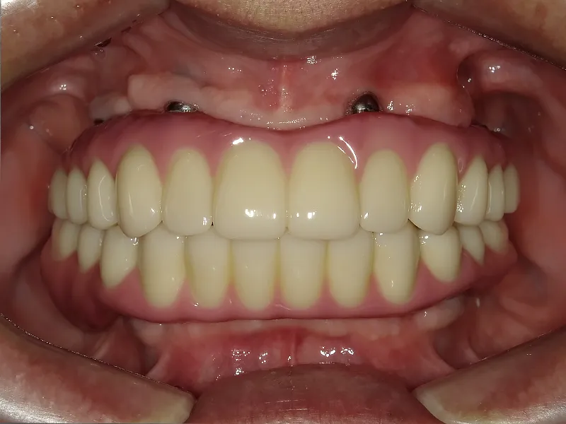 オールオン4治療後の口腔内写真1枚目（ジルコニア製上部構造を装着）