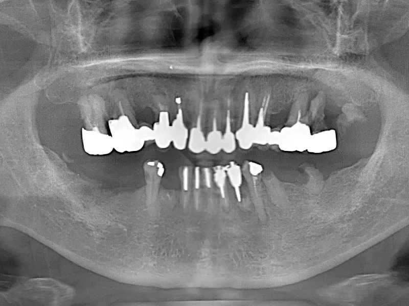 オールオン4治療前の口腔内写真2枚目（重度の歯周病とむし歯の状態）