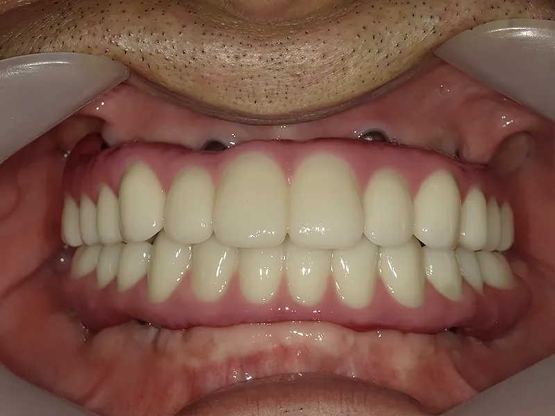 オールオン4治療後の口腔内写真1枚目（正常な噛み合わせに改善した状態）