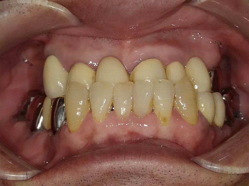 オールオン4治療前の口腔内写真1枚目（受け口と奥歯の欠損がある状態）