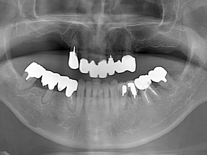 オールオン4治療前の口腔内写真2枚目（受け口と奥歯の欠損がある状態）